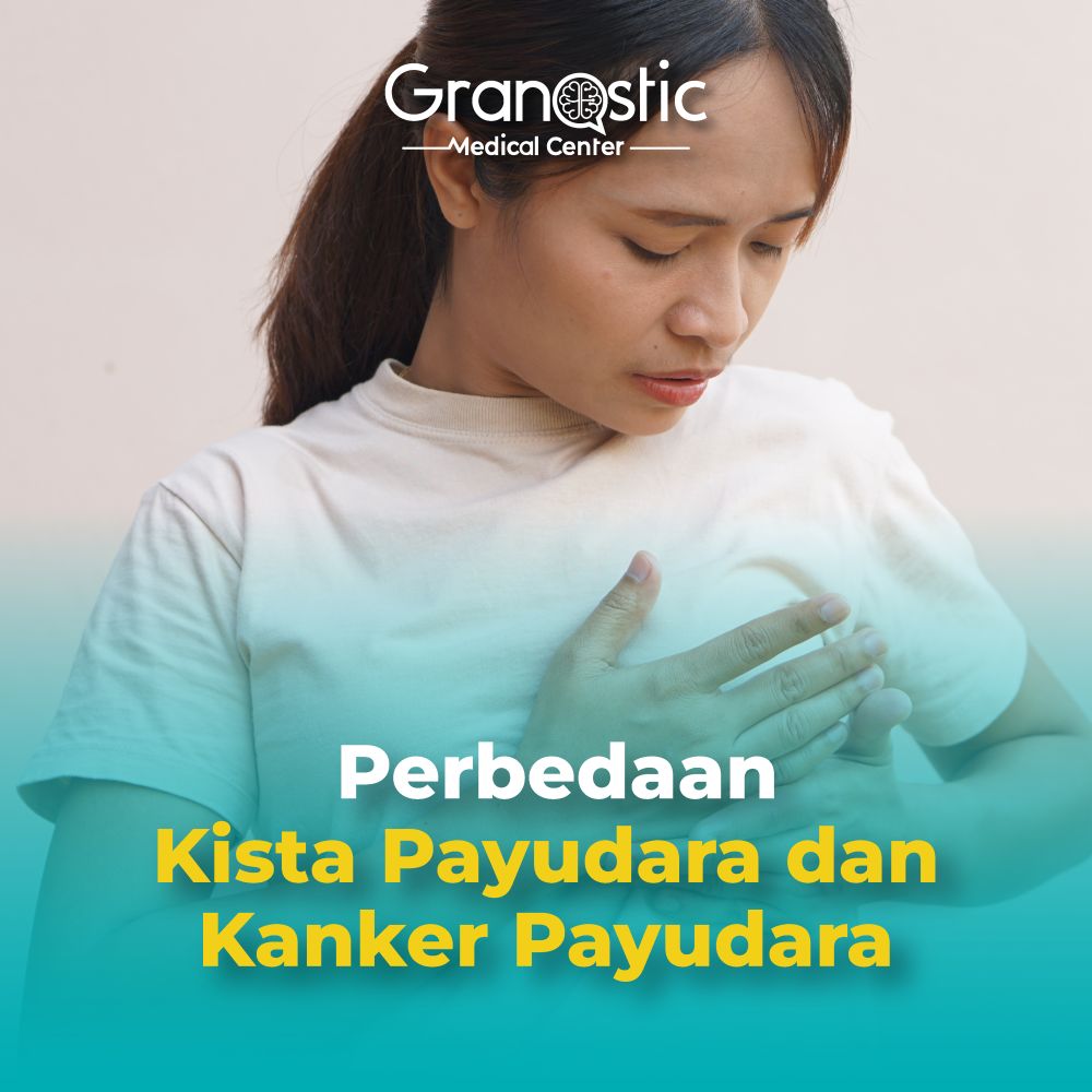 Perbedaan Kista Payudara dan Kanker Payudara