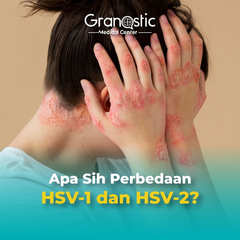 Apa Sih Perbedaan HSV-1 dan HSV-2?
